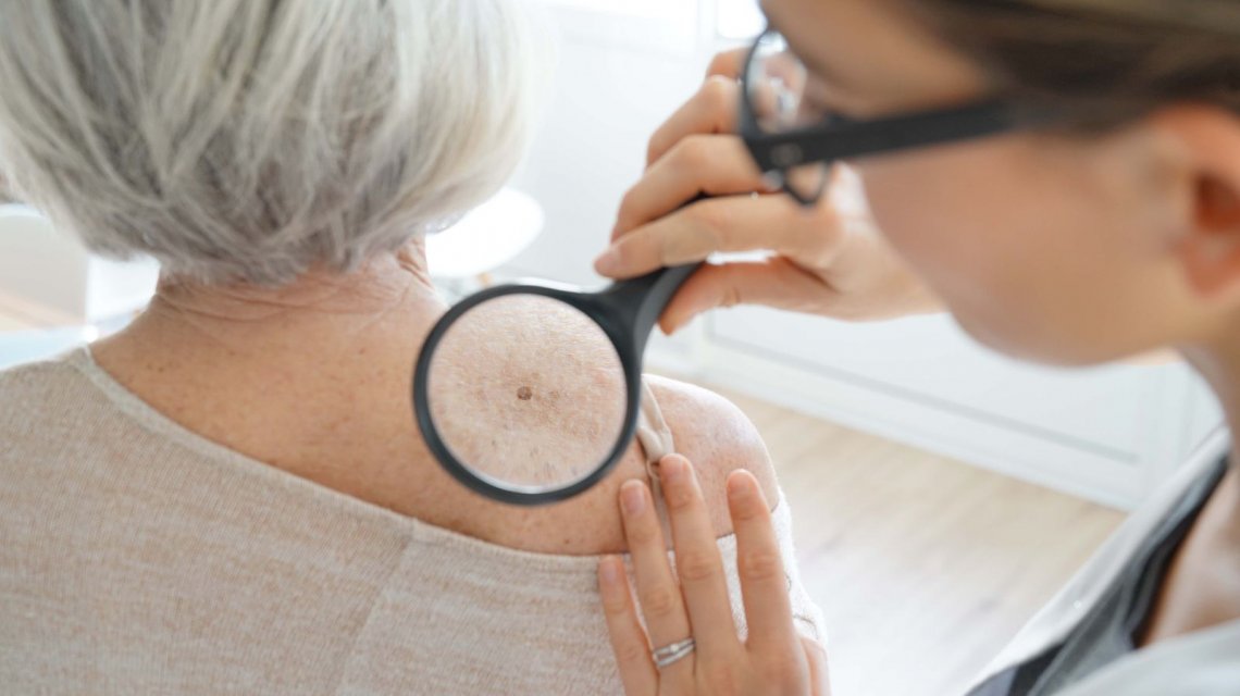 Cáncer de piel Cáncer de piel