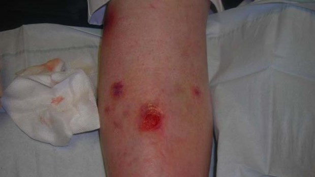 Úlceras Venosas Úlceras Venosas