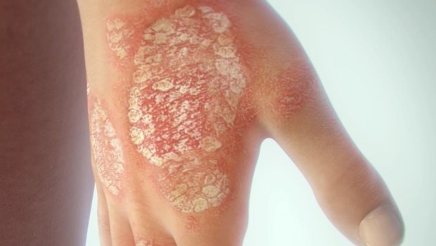 Psoriasis Psoriasis