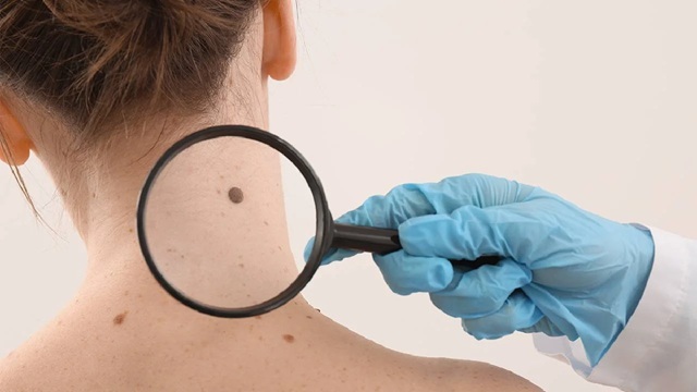 Es importante conocer cómo identificar el melanoma. Es importante conocer cómo identificar el melanoma.