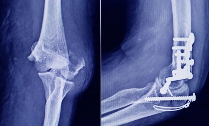 TORNILLOS EN CIRUGÍAS