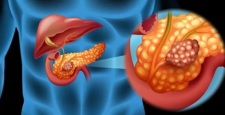 El cáncer de páncreas rara vez se detecta en fases iniciales.