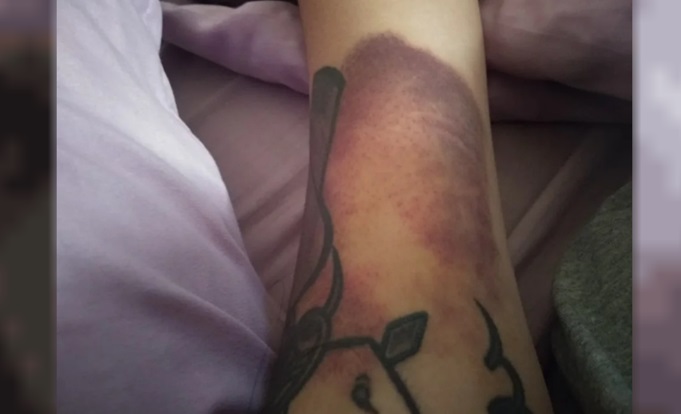 Una de las tantas lesiones que sufrió la joven
